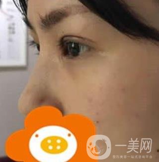 成都*做雙眼皮前后*果圖，附整形美容科價(jià)格收費(fèi)表一覽