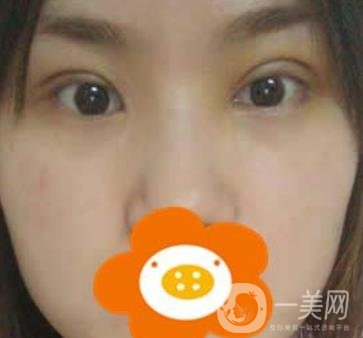 成都*做雙眼皮前后*果圖，附整形美容科價(jià)格收費(fèi)表一覽