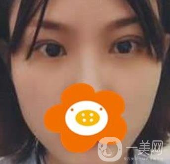 成都*做雙眼皮前后*果圖，附整形美容科價(jià)格收費(fèi)表一覽