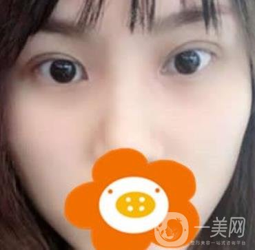 成都*做雙眼皮前后*果圖，附整形美容科價(jià)格收費(fèi)表一覽
