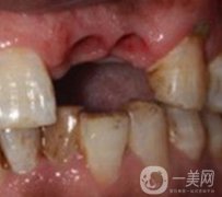 中大光華口腔醫(yī)院種植牙多少錢(qián)?價(jià)格表2020年項(xiàng)目明細(xì)一覽