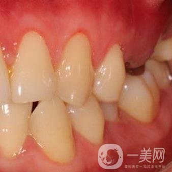 中大光華口腔醫(yī)院種植牙多少錢?價格表2020年項目明細一覽