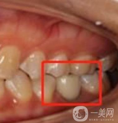 中大光華口腔醫(yī)院種植牙多少錢?價格表2020年項目明細一覽