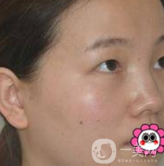 河南省人民醫(yī)院誰(shuí)做雙眼皮好？附案例及2020整形價(jià)格表