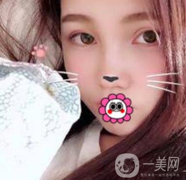 河南省人民醫(yī)院誰(shuí)做雙眼皮好？附案例及2020整形價(jià)格表