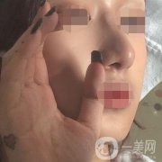 遼寧省人民醫(yī)院美容科怎么樣？附袁繼龍隆鼻案例