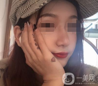 遼寧省人民醫(yī)院美容科怎么樣？附袁繼龍隆鼻案例