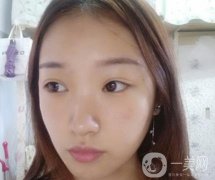 北大醫(yī)院美容價(jià)格表，附自體脂肪填充面部前后照