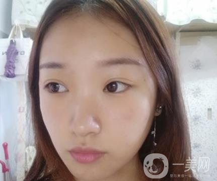 北大醫(yī)院美容價格表，附自體脂肪填充面部前后照