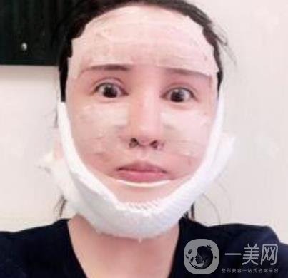 北大醫(yī)院美容價格表，附自體脂肪填充面部前后照