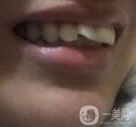 北京醫(yī)院整牙多少錢(qián)？牙齒矯正價(jià)格一覽表