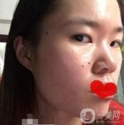 廣州荔灣區(qū)人民醫(yī)院*多少錢(qián)，美容科術(shù)后果展示