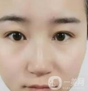 長(zhǎng)海醫(yī)院邢新做雙眼皮修復(fù)好嗎？?jī)r(jià)格表及案例詳情一覽