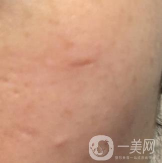 南通大學(xué)附屬醫(yī)院整形科價(jià)格表，附激光去疤案例