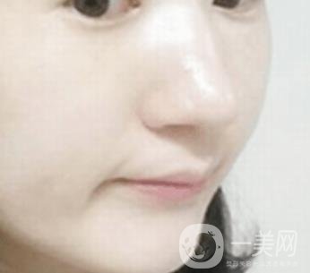 南通大學(xué)附屬醫(yī)院整形科價(jià)格表，附激光去疤案例