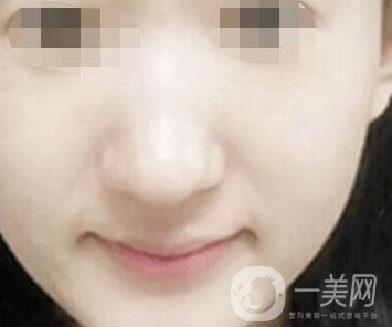 南通大學(xué)附屬醫(yī)院整形科價(jià)格表，附激光去疤案例
