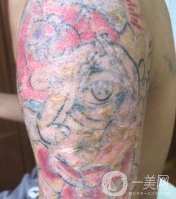 徐州市中心醫(yī)院整形科價格表，附洗紋身案例