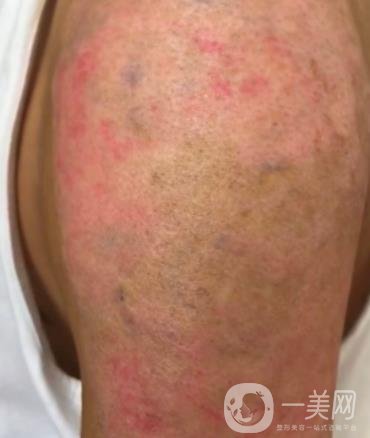 徐州市中心醫(yī)院整形科價格表，附洗紋身案例