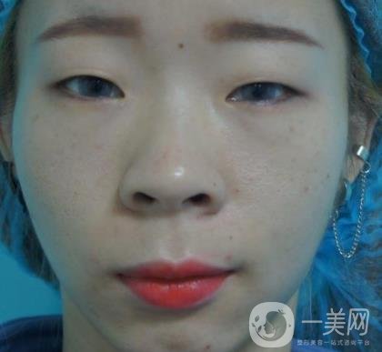 北京彤美醫(yī)療整形醫(yī)院價格表，附桂行軍雙眼皮術后*果一覽