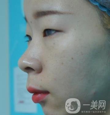 北京彤美醫(yī)療整形醫(yī)院價格表，附桂行軍雙眼皮術后*果一覽