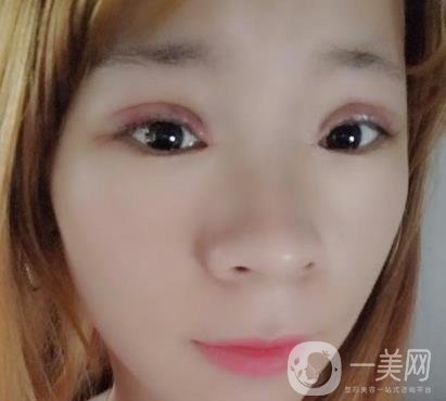 北京彤美醫(yī)療整形醫(yī)院價格表，附桂行軍雙眼皮術后*果一覽