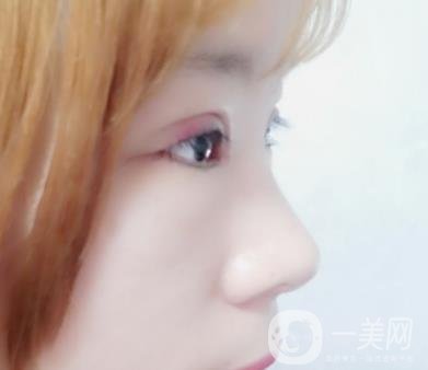 北京彤美醫(yī)療整形醫(yī)院價格表，附桂行軍雙眼皮術后*果一覽