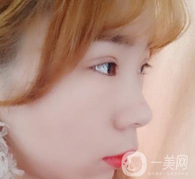 北京彤美醫(yī)療整形醫(yī)院價格表，附桂行軍雙眼皮術后*果一覽