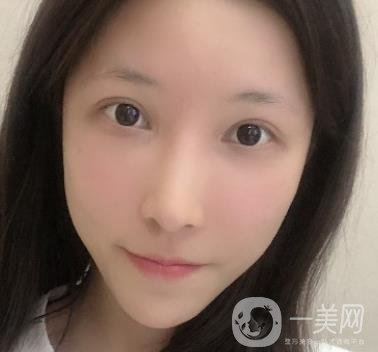 成都華美醫(yī)院做眉毛怎么樣?真實(shí)*果圖和價格一覽表展示
