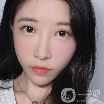 成都華美醫(yī)院做眉毛怎么樣?真實(shí)*果圖和價格一覽表展示