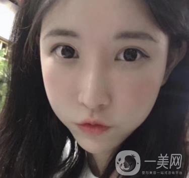 成都華美醫(yī)院做眉毛怎么樣?真實(shí)*果圖和價格一覽表展示