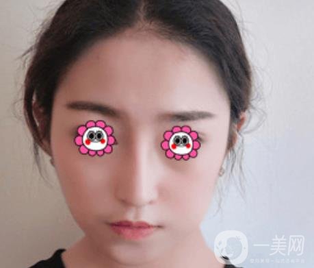 北京圣嘉榮整形價(jià)格表，內(nèi)附黃大勇整形醫(yī)生顴骨內(nèi)推案例*果圖展示