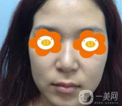 長沙貝美醫(yī)院做鼻子怎么樣?一覽價格表費用詳情