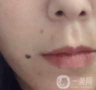 重慶附一院整形科價(jià)格表2020年公布，附祛痣整形日記