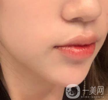 重慶附一院整形科價格表2020年公布，附祛痣整形日記