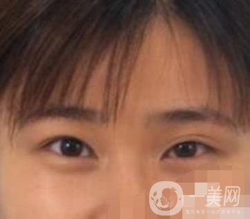 北京韓勛雙眼皮修復怎么樣？附整形價格表一覽