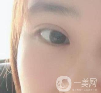 北京韓勛雙眼皮修復怎么樣？附整形價格表一覽