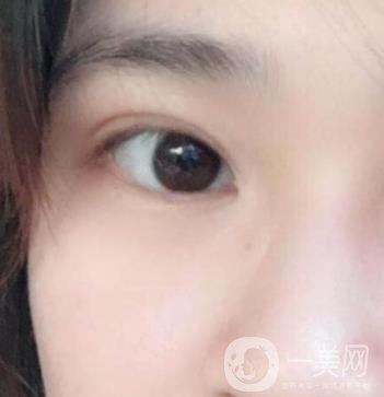 北京韓勛雙眼皮修復怎么樣？附整形價格表一覽