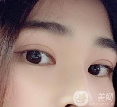北京韓勛雙眼皮修復怎么樣？附整形價格表一覽