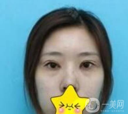 濟(jì)寧附屬醫(yī)院做雙眼皮多少錢？附真實(shí)案例及整形價(jià)格表