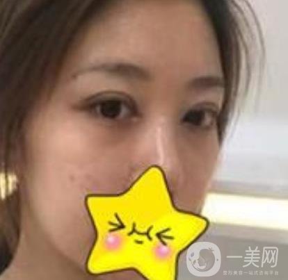 濟(jì)寧附屬醫(yī)院做雙眼皮多少錢？附真實(shí)案例及整形價(jià)格表