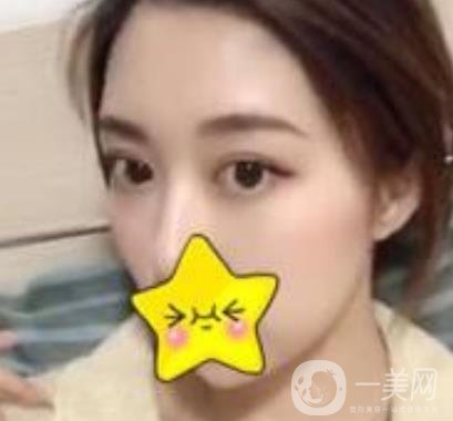 濟(jì)寧附屬醫(yī)院做雙眼皮多少錢？附真實(shí)案例及整形價(jià)格表