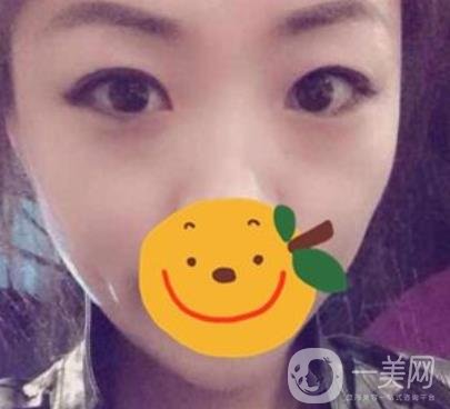 昆明市第一人民醫(yī)院雙眼皮多少錢(qián)？附案例及2020全新整形價(jià)格表
