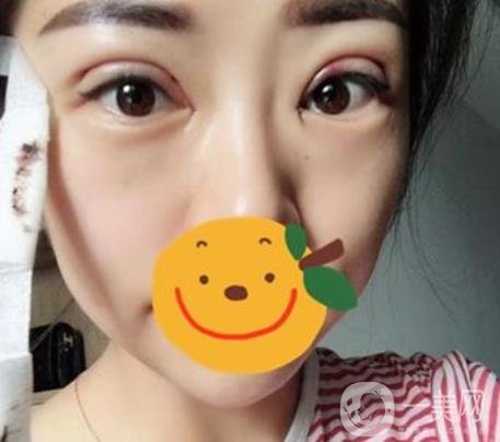昆明市第一人民醫(yī)院雙眼皮多少錢(qián)？附案例及2020全新整形價(jià)格表
