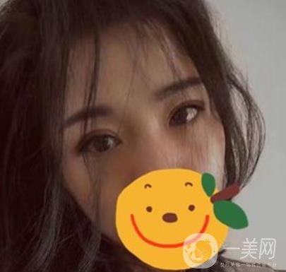 昆明市第一人民醫(yī)院雙眼皮多少錢(qián)？附案例及2020全新整形價(jià)格表