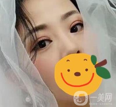 昆明市第一人民醫(yī)院雙眼皮多少錢(qián)？附案例及2020全新整形價(jià)格表
