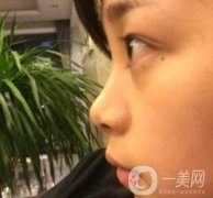 上海瑞金醫(yī)院王輝隆鼻價(jià)格一覽表，附整形案例在線展示