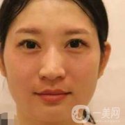 武漢禾麗趙星星隆鼻怎么樣？附鼻部整形價(jià)格一覽