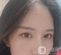 北京處布仁醫(yī)生隆鼻案例，看整形價(jià)格及果怎么樣