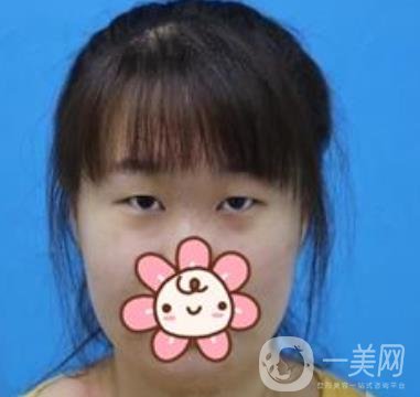 上海華美楊亞益做眼睛多少錢？?jī)r(jià)格表及案例詳情