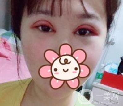 上海華美楊亞益做眼睛多少錢？?jī)r(jià)格表及案例詳情
